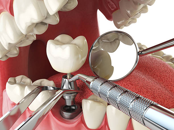 Best Emergency Tooth Extraction in North Fair Oaks, CA